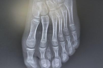 Batman'da nadir 7 parmaklı ayak vakası başarıyla tedavi edildi