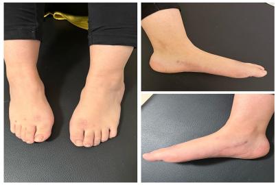 Şanlıurfa’da milyonda bir görülen hastalıkta umut veren başarı