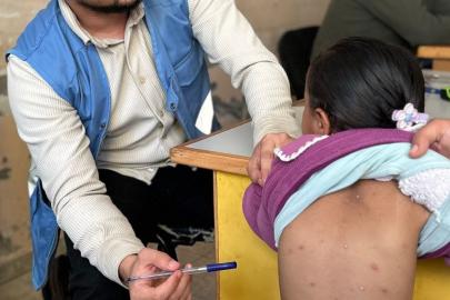 UNRWA: Gazze'de cilt hastalıklarının yayılması yazın büyük bir sağlık krizinin habercisi